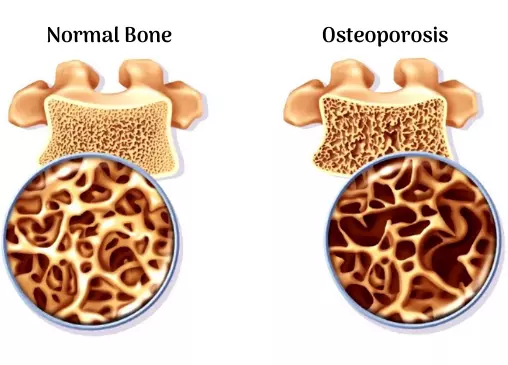 Osteoporosis