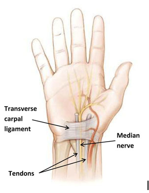 Carpal Tunnel Syndrome Signs and Symptoms | carpal tunnel syndrome ...